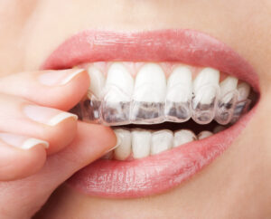 invisalign